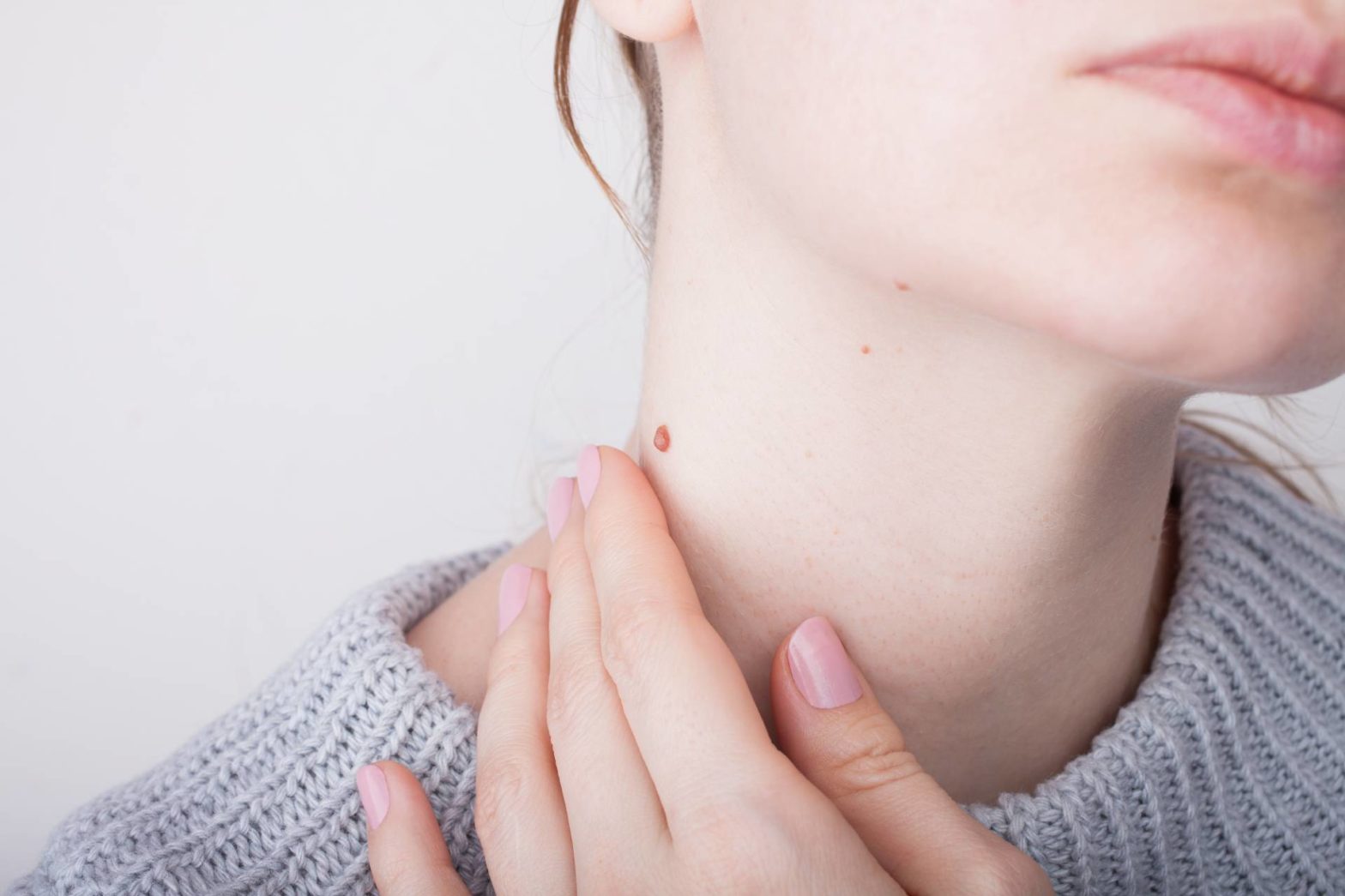 remove skin tags Sydeny